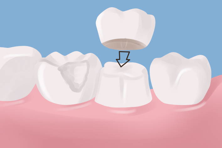 Dr Ergun Senay, dental crowns