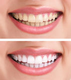 Teeth whitening, tooth discoloration, before and after tooth