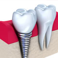 dental implant