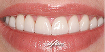 Porcelain Crowns after