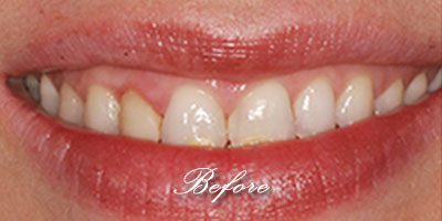 Porcelain Crowns before