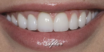 Porcelain Veneers after