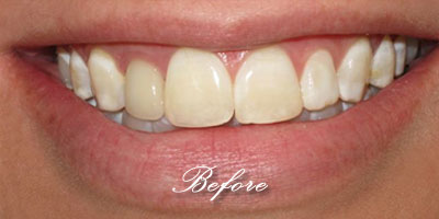 Porcelain Veneers before