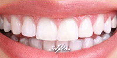 Whitening after