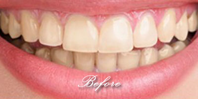 Whitening before