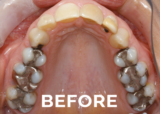 Before cerec