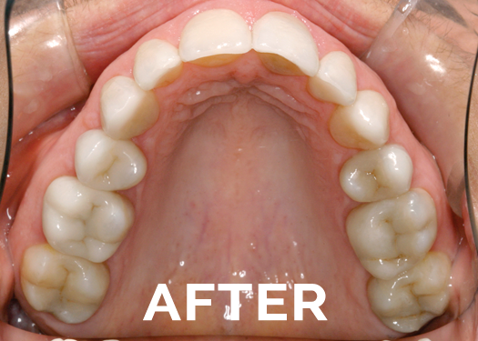 After cerec