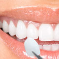 Veneers, procedures